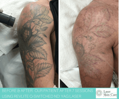 Tattoo Removal Blog - Laser Skin Care